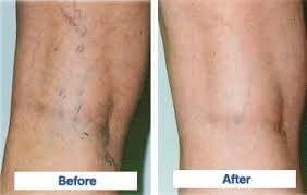 Sclerotherapy Spider Vein Treatment Before and After