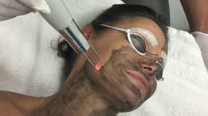 Onyx Laser Facial Treatment Santa Fe, NM 